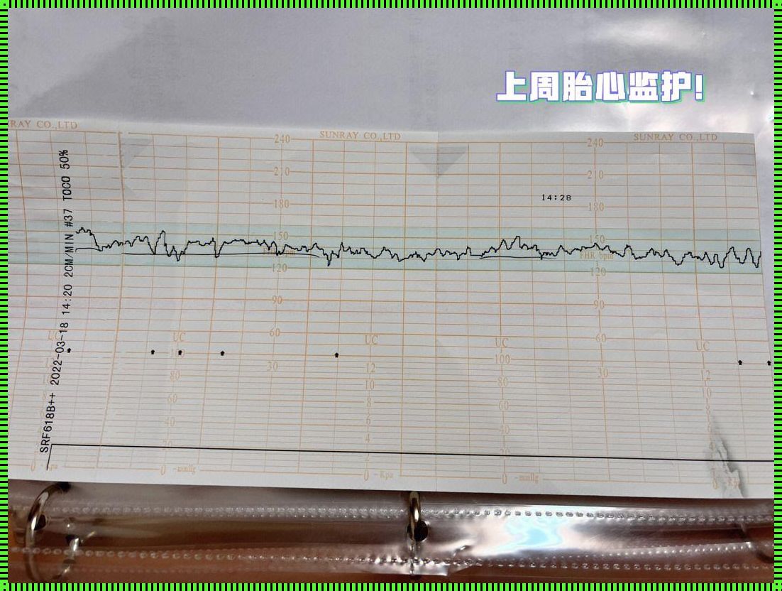 胎监不合格什么意思 胎心监测不合格 严重吗?