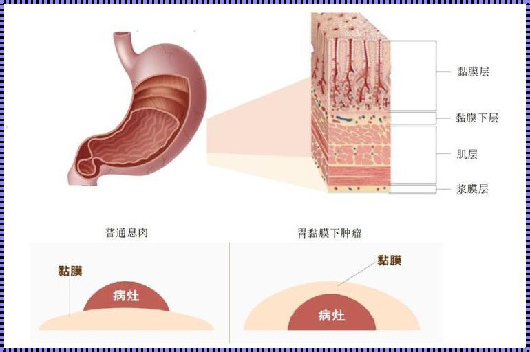 早期胃粘膜内癌能活多久(胃癌早期能活多久)