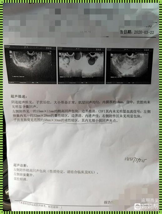 《小腹疼痛，宫外孕疑云笼罩》