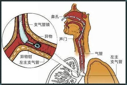 气管堵住几分钟会死（吃东西被呛了.会死吗。什么情况下会死。）