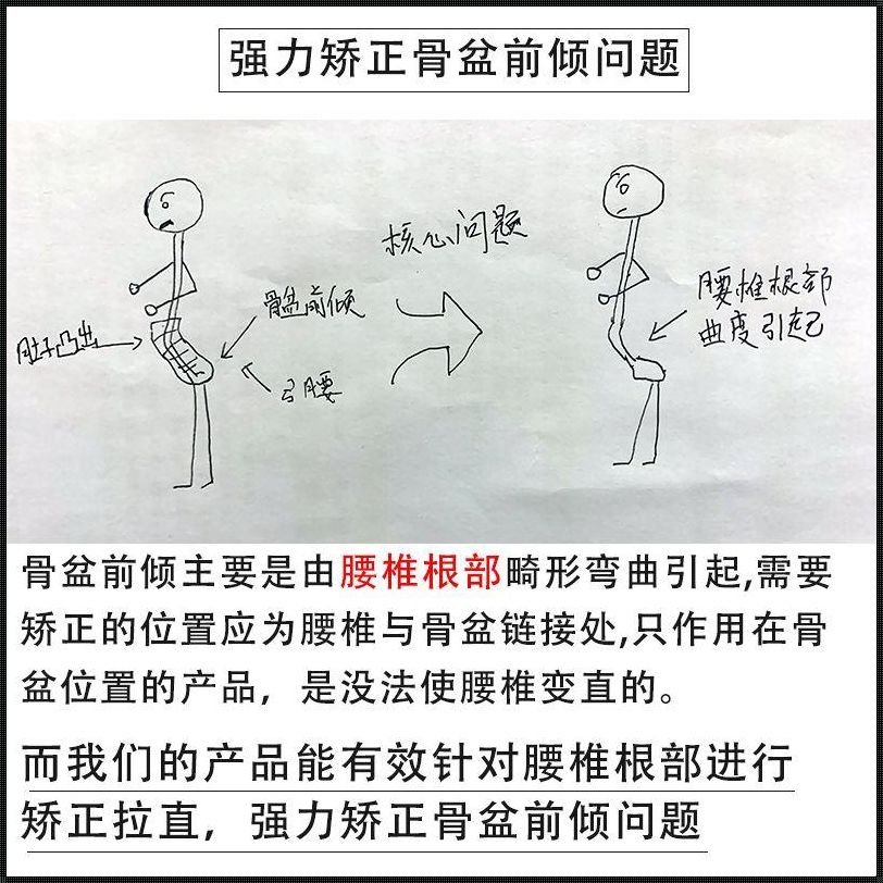 腰椎前倾，你怎么纠正？