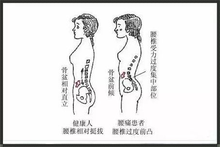 腰椎前凸与后凸之影像探究——郴州实例解析