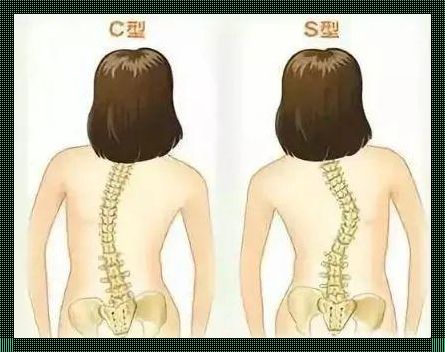 脊柱前凸矫正之道：健康生活从正确姿势开始