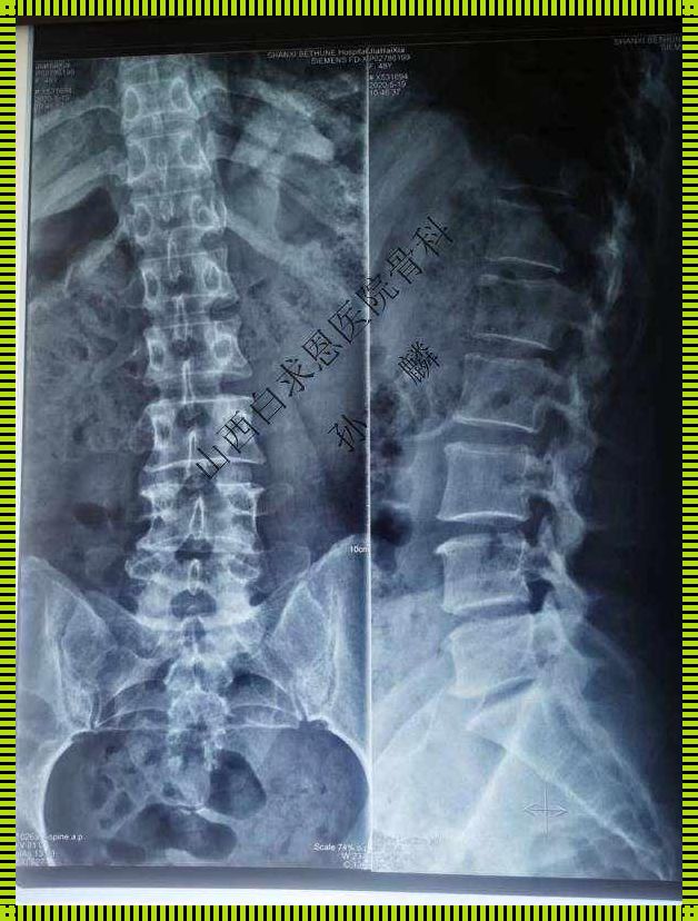 腰椎间盘突出脊柱侧弯：科技助力邯郸患者解答难题