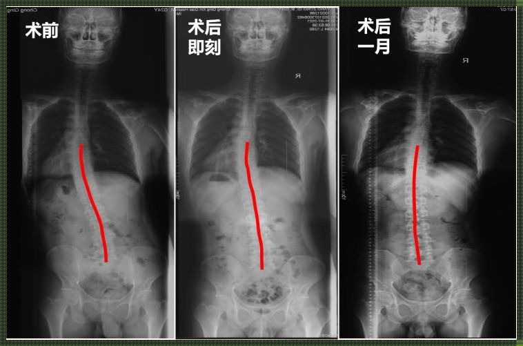 腰椎间盘突出脊柱侧弯：科技助力邯郸患者解答难题