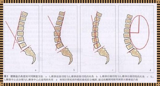 腰椎前突探秘：安丘科技助你权益保障