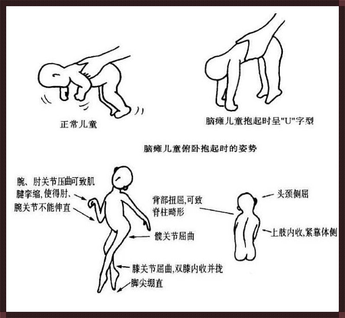 宝宝脑瘫八个动作识别图谱解析与应用