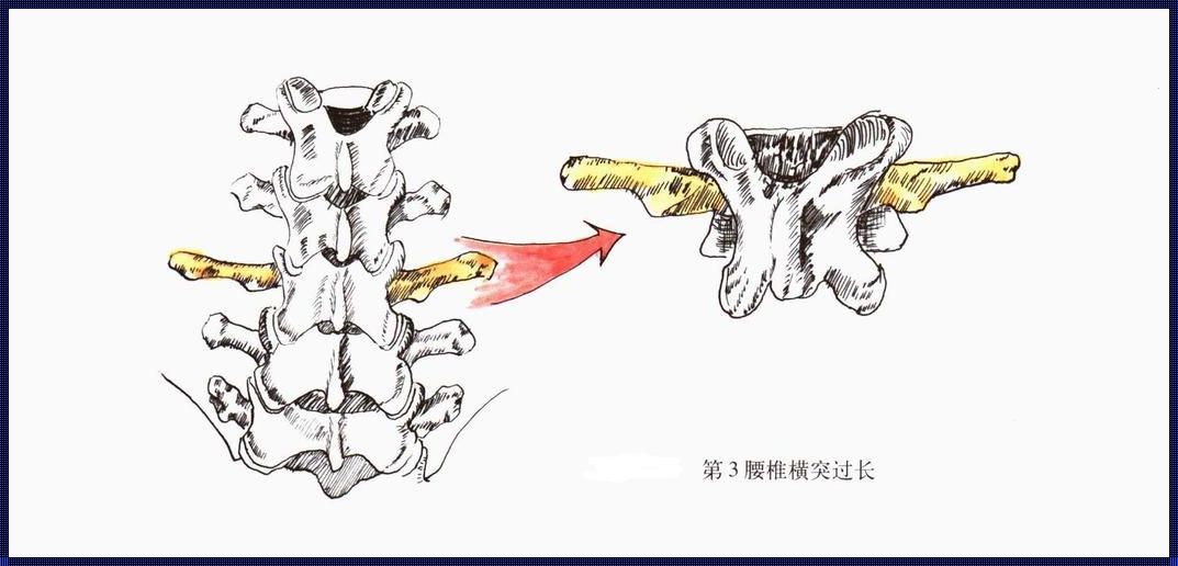 腰椎前凸和后突：中山惊现的独特现象