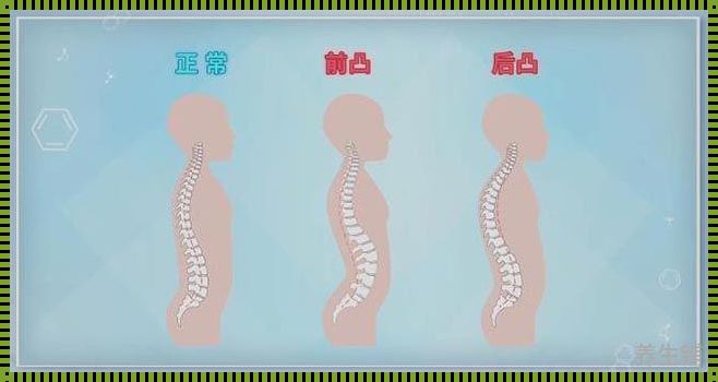 崇州应用之道：脊柱前凸矫正要及时