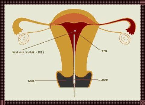 眼科科技新突破：宫腔灌注输卵管之谜