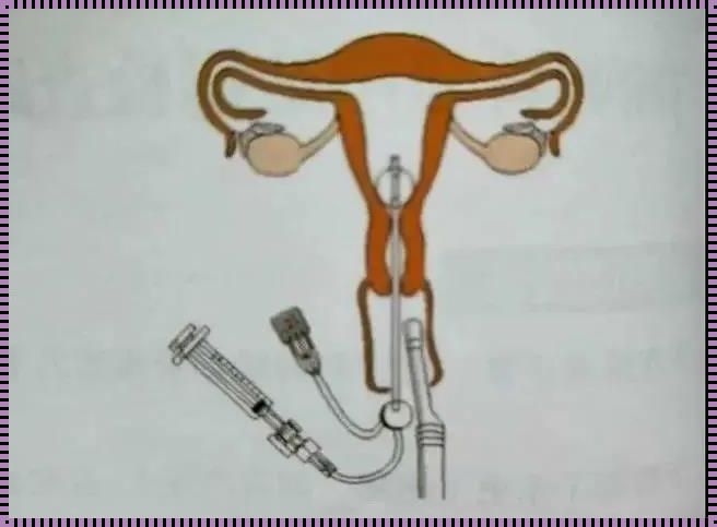 眼科科技新突破：宫腔灌注输卵管之谜