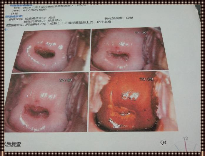 宫颈口正常图片揭秘，带你了解女性生殖系统的奥秘