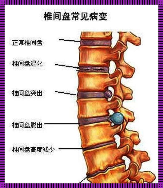 腰椎盘突出前突揭秘：背后的真相让你大吃一惊