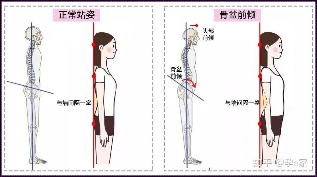 孩子挺肚子腰往前凸的原因