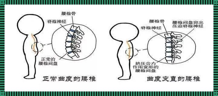 科技助力腰椎变形自我矫正——贵阳倒计时行动来袭！