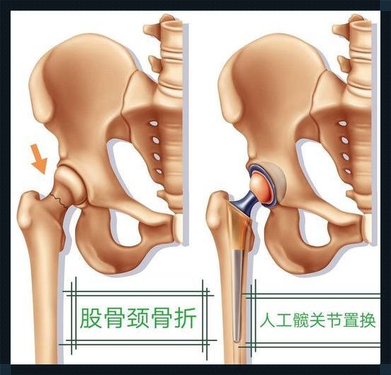 郎平的髋关节：体育精神与科技的融合